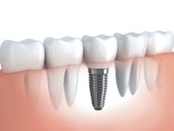 Dental implants manhattan ny