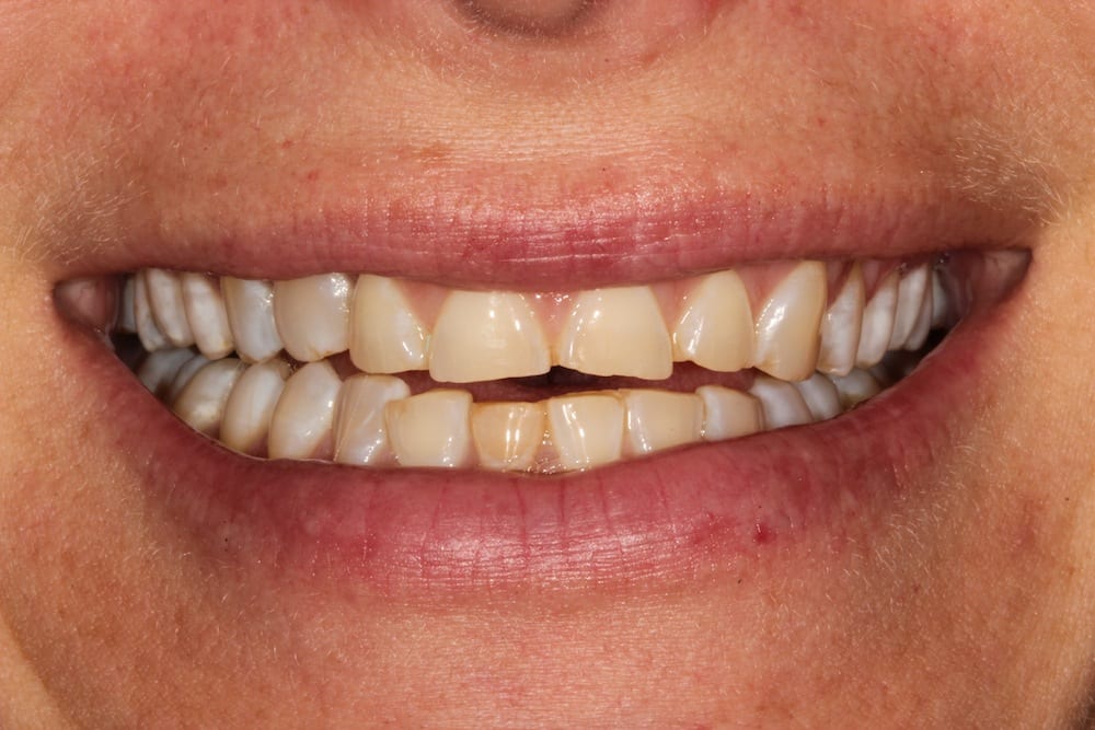 before cosmetic dentistry by Brad Gorsky, DMD, PC