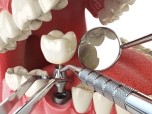 August is Dental Implant Month!