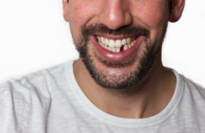 replace lost teeth in Manhattan NY