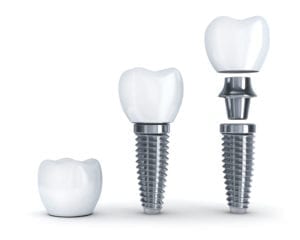 Dental Implants in Manhattan New York