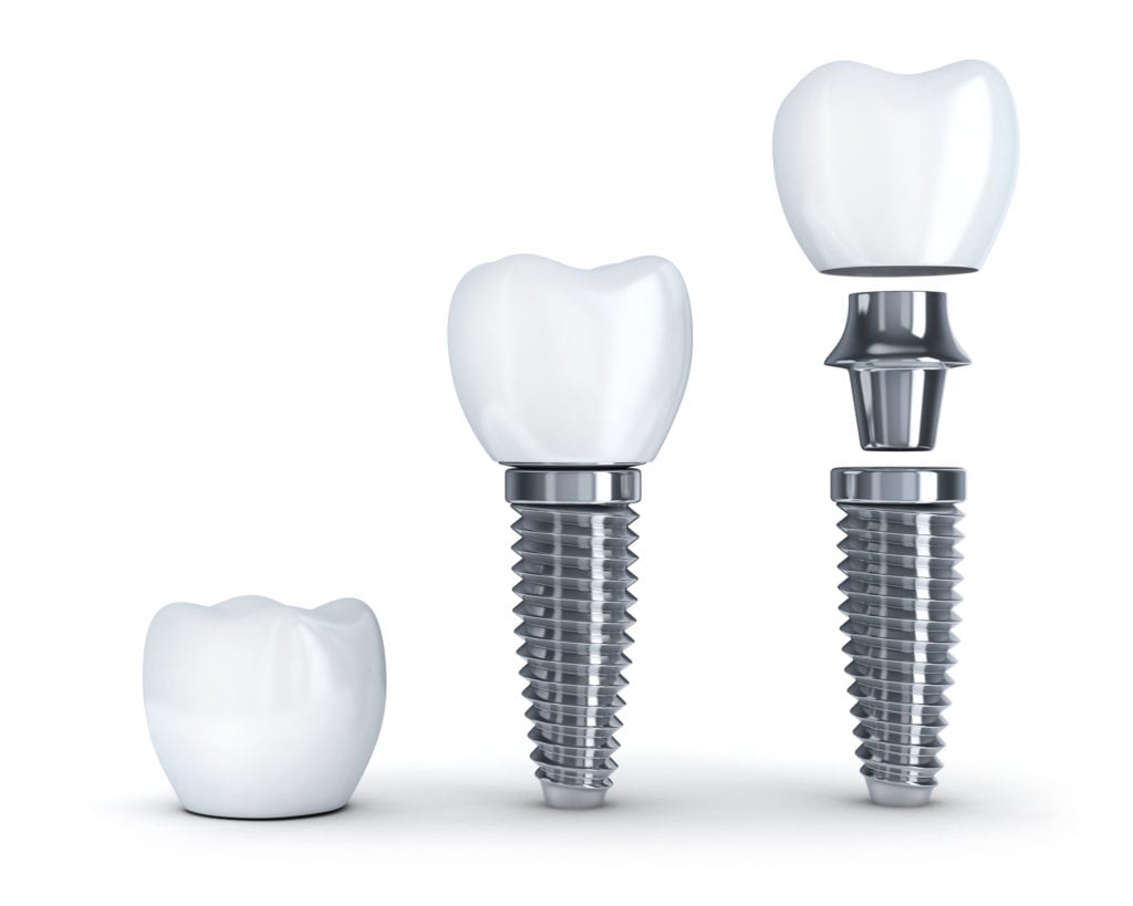 Dental Implants Procedure in Larchmont, NY