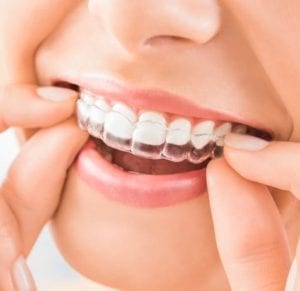 Transform Your Smile With Invisible Braces