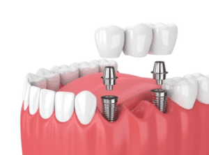 3D image of implant supported bridge dentist in Manhattan New York